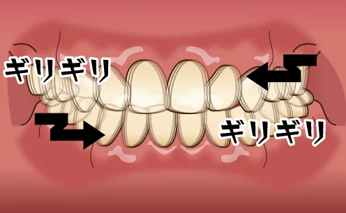 歯の全体をこすり合わせるタイプで運動時や就寝時に無意識で行っている事が多く全体の歯がすり減っていく