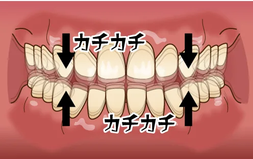 上下の歯をカチカチと噛みあわせるタイプ。それほど大きな力ではないため他のタイプよりは軽度