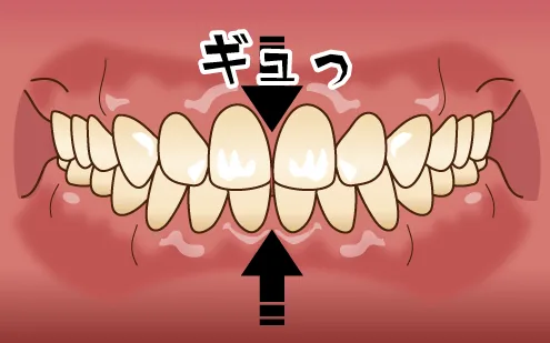 上下の歯を無意識に噛みしめてしまうタイプで日中・夜間に関係なく噛みしめる