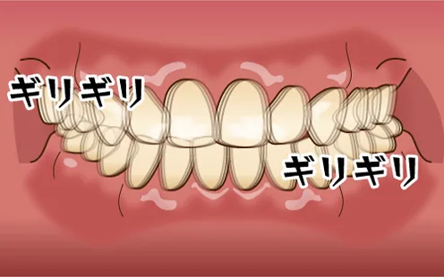 ナッシングは歯の全体ではなく一定の場所だけでこすり合わせるタイプで就寝時に音が鳴る場合がある