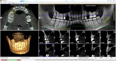 精密な診断のため、歯科用CTを完備｜歯科用CT