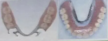 コバルトクロム床義歯