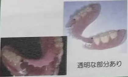 ノンクラスプ義歯