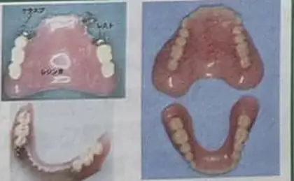 プラスチック義歯