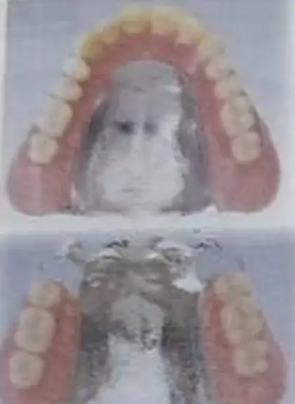 チタン床義歯